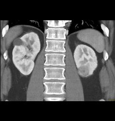 Renal Cell Carcinoma Left Kidney - CTisus CT Scan