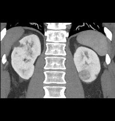 Renal Cell Carcinoma Left Kidney - CTisus CT Scan