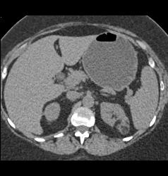 Left Renal Angiomyolipoma - CTisus CT Scan