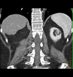 Left Renal Angiomyolipoma - CTisus CT Scan