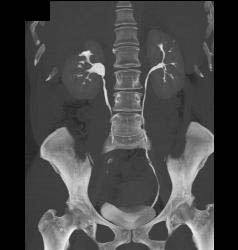 Left Renal Angiomyolipoma - CTisus CT Scan