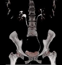 Left Renal Angiomyolipoma - CTisus CT Scan