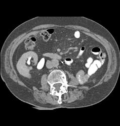 Normal Post Left Nephrectomy - CTisus CT Scan