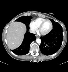 Recurrent Renal Cell Carcinoma With Liver Metastases - CTisus CT Scan