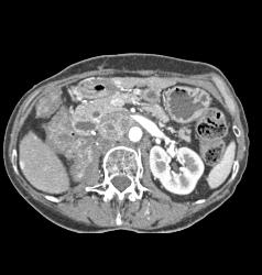 Recurrent Renal Cell Carcinoma With Liver Metastases - CTisus CT Scan