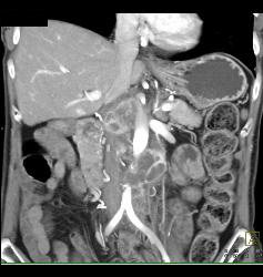 Recurrent Renal Cell Carcinoma With Liver Metastases - CTisus CT Scan