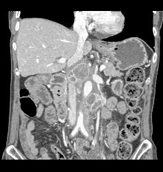 Recurrent Renal Cell Carcinoma With Liver Metastases - CTisus CT Scan