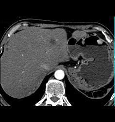 Renal Cell Carcinoma Metastatic to the Stomach - CTisus CT Scan