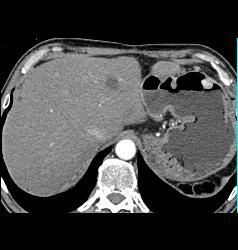 Renal Cell Carcinoma Metastatic to the Stomach - CTisus CT Scan