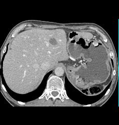 Renal Cell Carcinoma Metastatic to the Stomach - CTisus CT Scan