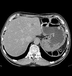 Renal Cell Carcinoma Metastatic to the Stomach - CTisus CT Scan