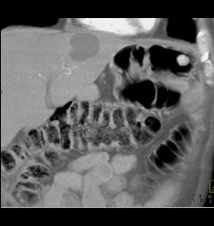 Renal Cell Carcinoma Metastatic to the Stomach - CTisus CT Scan