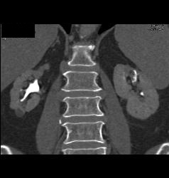 Transitional Cell Cancer (TCC) of Left Kidney- See CT Urogram and Full Sequence of Images - CTisus CT Scan