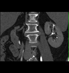 Transitional Cell Cancer (TCC) of Left Kidney- See CT Urogram and Full Sequence of Images - CTisus CT Scan