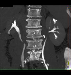 Transitional Cell Cancer (TCC) of Left Kidney- See CT Urogram and Full Sequence of Images - CTisus CT Scan