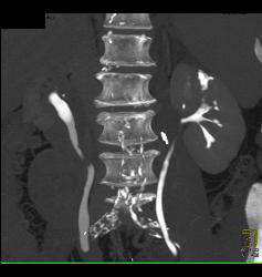 Transitional Cell Cancer (TCC) of Left Kidney- See CT Urogram and Full Sequence of Images - CTisus CT Scan