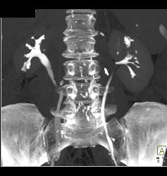 Transitional Cell Cancer (TCC) of Left Kidney- See CT Urogram and Full Sequence of Images - CTisus CT Scan