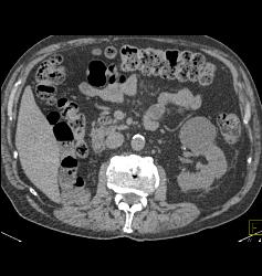 Solid Renal Cell Carcinoma (RCC) Adjacent to A Cyst. Prior Right Nephrectomy - CTisus CT Scan