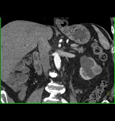 Solid Renal Cell Carcinoma (RCC) Adjacent to A Cyst. Prior Right Nephrectomy - CTisus CT Scan