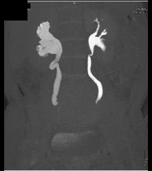 Dilated Right Ureter and Renal Pelvis With CT Urography - CTisus CT Scan