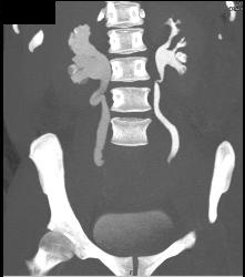 Dilated Right Ureter and Renal Pelvis With CT Urography - CTisus CT Scan