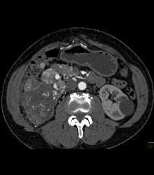 Renal Cell Carcinoma Invades the Inferior Vena Cava (IVC) and Right Atrium With Neovascularity - CTisus CT Scan