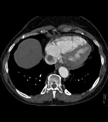 Renal Cell Carcinoma Invades the Inferior Vena Cava (IVC) and Right Atrium With Neovascularity - CTisus CT Scan