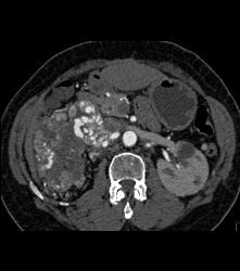 Renal Cell Carcinoma Invades the Inferior Vena Cava (IVC) and Right Atrium With Neovascularity - CTisus CT Scan