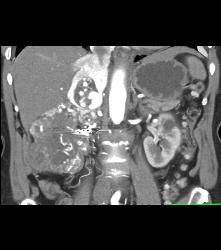 Renal Cell Carcinoma Invades the Inferior Vena Cava (IVC) and Right Atrium With Neovascularity - CTisus CT Scan