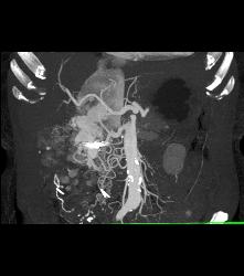 Renal Cell Carcinoma Invades the Inferior Vena Cava (IVC) and Right Atrium With Neovascularity - CTisus CT Scan