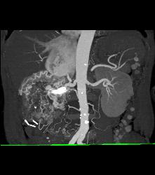 Renal Cell Carcinoma Invades the Inferior Vena Cava (IVC) and Right Atrium With Neovascularity - CTisus CT Scan