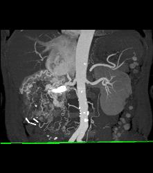 Renal Cell Carcinoma Invades the Inferior Vena Cava (IVC) and Right Atrium With Neovascularity - CTisus CT Scan