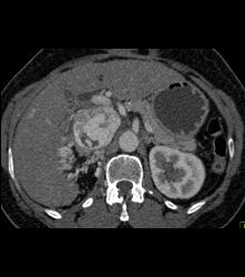 Renal Cell Carcinoma Invades the Inferior Vena Cava (IVC) and Right Atrium With Neovascularity - CTisus CT Scan