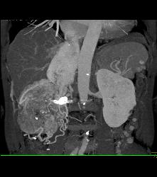 Renal Cell Carcinoma Invades the Inferior Vena Cava (IVC) and Right Atrium With Neovascularity - CTisus CT Scan
