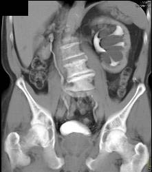 Parapelvic Cysts - CTisus CT Scan