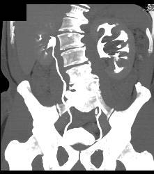 Parapelvic Cysts - CTisus CT Scan