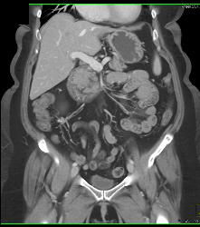 Parapelvic Cysts - CTisus CT Scan