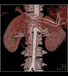 Retroaortic Renal Vein - CTisus CT Scan