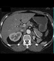 1 Cm Recurrence in Left Renal Bed - CTisus CT Scan