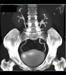 CT Urogram With Tracking of Ureter - CTisus CT Scan