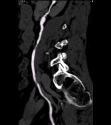 CT Urogram With Tracking of Ureter - CTisus CT Scan