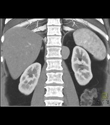 Unusual Bronchogenic Cyst Off Diaphragm Presents as A New Renal Mass - CTisus CT Scan