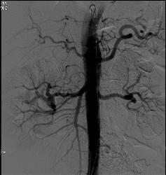 Fibromuscular Dysplasia (FMD) of Right Renal Artery the Mesenteric Vessels Were Normal - CTisus CT Scan