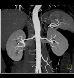 Fibromuscular Dysplasia (FMD) of Right Renal Artery the Mesenteric Vessels Were Normal - CTisus CT Scan