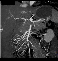 Fibromuscular Dysplasia (FMD) of Right Renal Artery the Mesenteric Vessels Were Normal - CTisus CT Scan