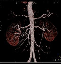 Fibromuscular Dysplasia (FMD) of Right Renal Artery the Mesenteric Vessels Were Normal - CTisus CT Scan