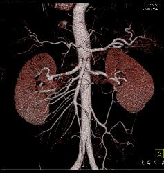 Fibromuscular Dysplasia (FMD) of Right Renal Artery the Mesenteric Vessels Were Normal - CTisus CT Scan