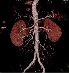 Fibromuscular Dysplasia (FMD) of Right Renal Artery the Mesenteric Vessels Were Normal - CTisus CT Scan