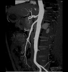 Fibromuscular Dysplasia (FMD) of Right Renal Artery the Mesenteric Vessels Were Normal - CTisus CT Scan