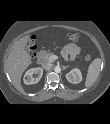 1 Cm Angiomyolipoma (AML) - CTisus CT Scan